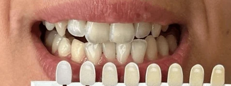 BEYOND fogfeh&eacute;r&iacute;t&eacute;s előtt