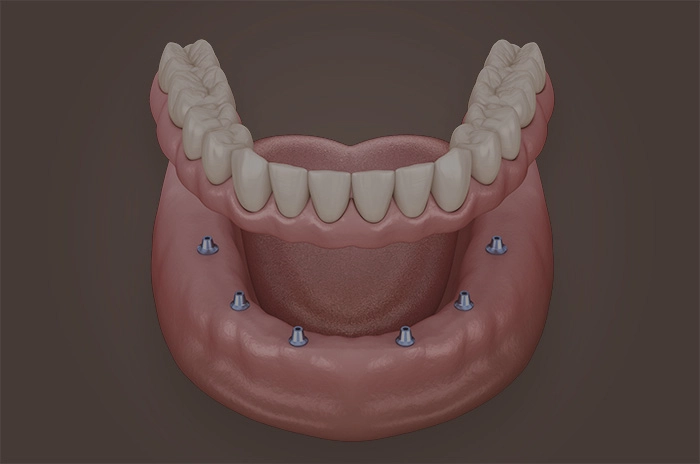 Fogászati protézis